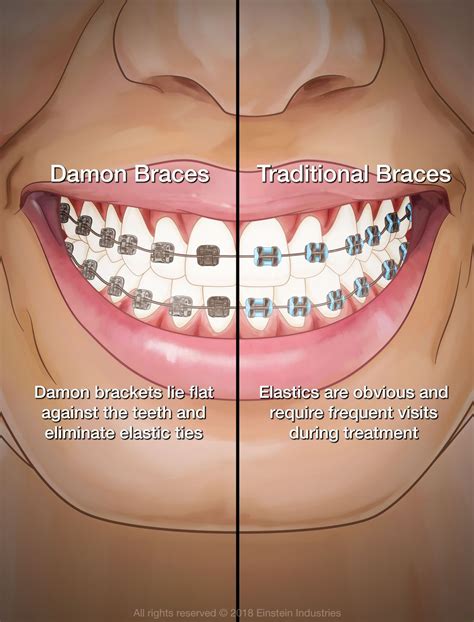 damon brackets vs metal braces|damon braces before and after.